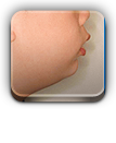 숨길교정 무턱교정