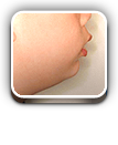 숨길교정 무턱교정